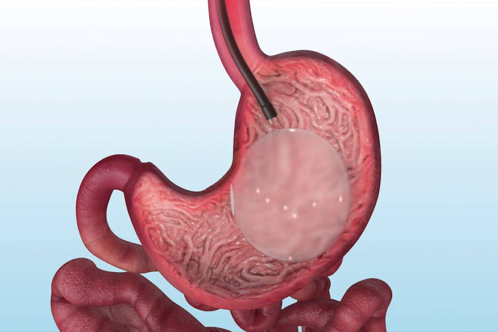 Balón intragástrico: Una alternativa para el tratamiento de sobrepeso y obesidad